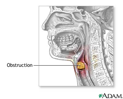 Indications Indications