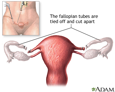 Tubal ligation Tubal ligation