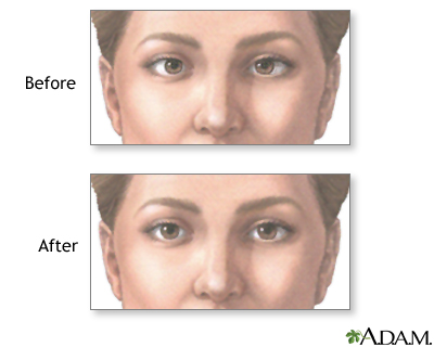 Before and after strabismus repair Before and after strabismus repair