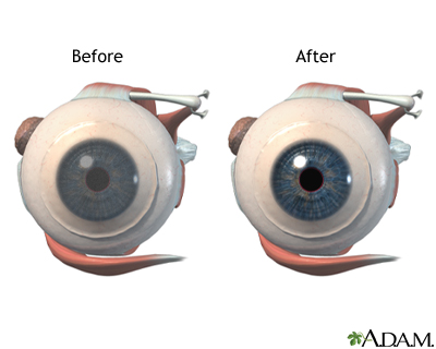 Before and after corneal surgery Before and after corneal surgery