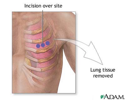 Incision for lung biopsy Incision for lung biopsy