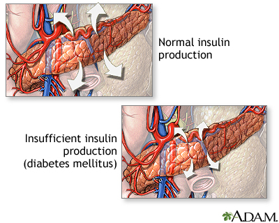 Insulin production and diabetes Insulin production and diabetes