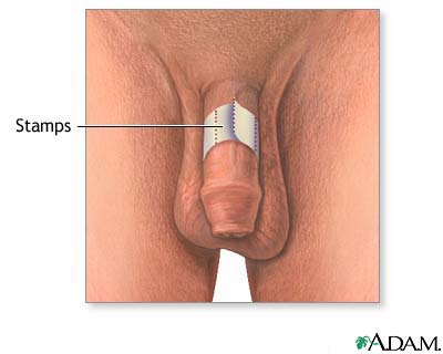 Erection self-test Erection self-test