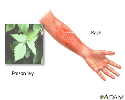 Rash Rash