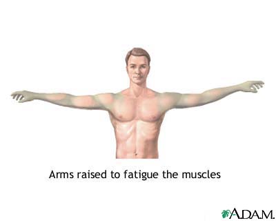 Muscle fatigue Muscle fatigue