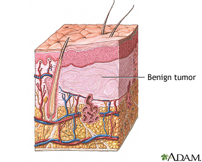 Benign tumor of the skin Benign tumor of the skin