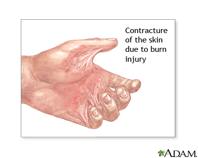 Contracture deformity Contracture deformity