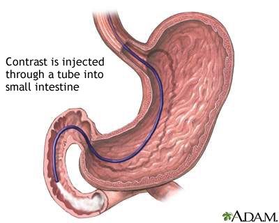 Small intestine contrast injection Small intestine contrast injection