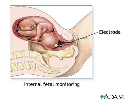 Internal fetal monitoring Internal fetal monitoring