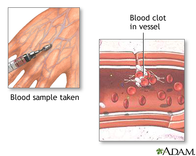 Blood clots Blood clots