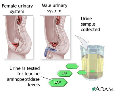 Leucine aminopeptidase urine test Leucine aminopeptidase urine test