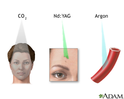 Laser therapy Laser therapy