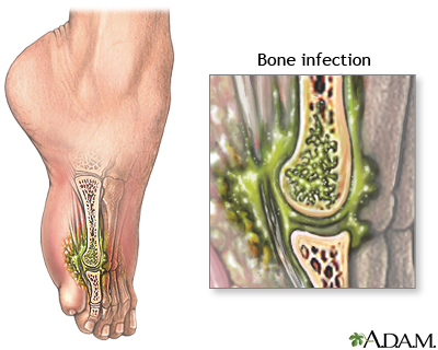 Osteomyelitis Osteomyelitis