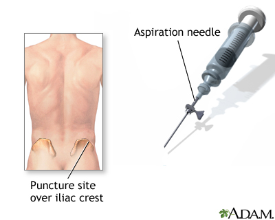 Bone biopsy Bone biopsy