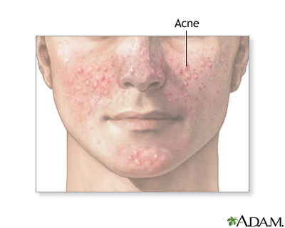 Acne Acne