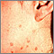 Warts - flat on the cheek and neck
