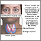 Graves disease