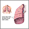 Miliary tuberculosis