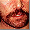 Dermatitis - seborrheic on the face