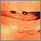Keloid - pigmented