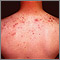 Acne - cystic on the back Acne - cystic on the back