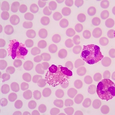 Eosinophilic Disorders