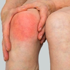 Infectious Arthritis