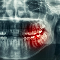 Tooth Disorders