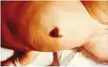 Close up showing abdominal distension and umbilical hernia.