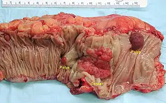 Gross appearance of an opened colectomy specimen containing two adenomatous polyps (the brownish oval tumors above the labels, attached to the normal beige lining by a stalk) and one invasive colorectal carcinoma (the crater-like, reddish, irregularly-shaped tumor located above the label)
