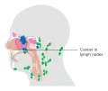 Ethmoid sinus cancer that has spread to the lymph nodes