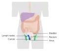 Stage 3 anal cancer