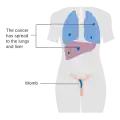 Stage 4 choriocarcinoma