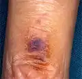 Possible smoker's melanosis. Discoloured skin on finger. Area close to cigarette glow.