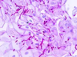 Micrograph of esophageal candidiasis showing hyphaes