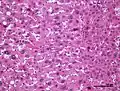 Inflammatory hepatocellular adenoma