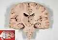 Human brain frontal (coronal) section. Thalamus label is 10.