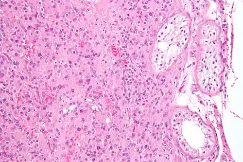 Intermediate magnification micrograph of a Leydig cell tumour, H&E stain