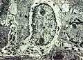 Melanocyte with melanin granules in dendrite. PMID 6200593