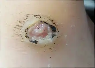 Erosion on the sole, close-up (large-scale). If deeper, it would be an ulcer