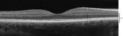 Spectral-Domain OCT macula cross-section scan.