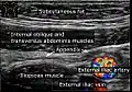 Ultrasound of a normal appendix for comparison.