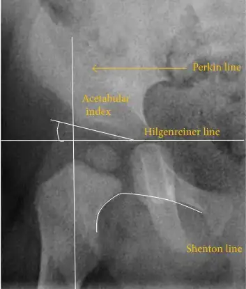 Normal hip.[50]
